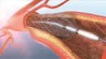 Japan Coronary Stents Market Size Share Growth Forecast 2025-2033